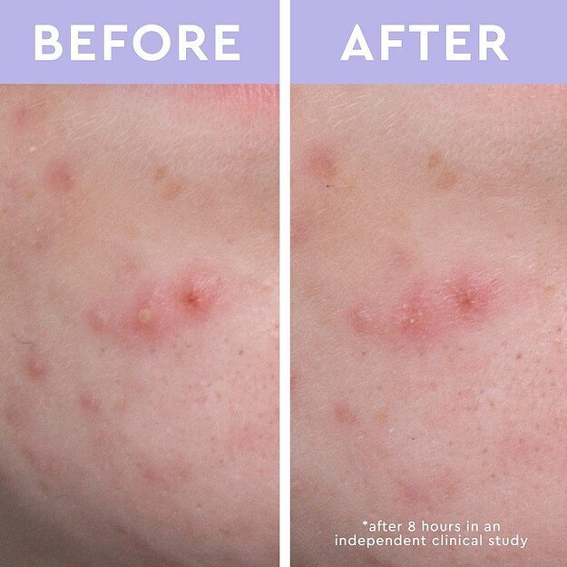 Florence by Mills - Skincare Cleanse Spot a Spot Patches 1 1