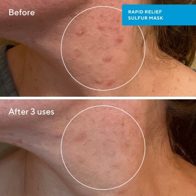 Murad - Rapid Relief Sulfur Mask 75 ml 1